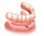 Prothese op implantaten